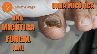 Uña micótica  Fungal nail  Unha micótica Podología Integral [upl. by Merrel639]