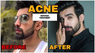 HOW TO REMOVE ACNE OVERNIGHT  NATURAL  PIMPLES  FAST ACNE TREATMENT MARKS HOME REMEDIES HINDI [upl. by Noiraa]