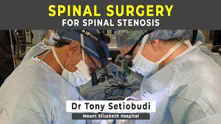 SURGERY FOR SPINAL STENOSIS [upl. by Dorita]