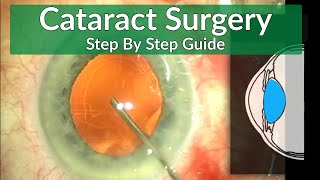 Cataract Surgery Teaching  A Beginners Guide [upl. by Anigar]