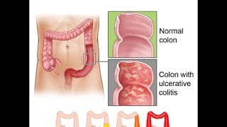 Ulcerative Colitis [upl. by Scammon]