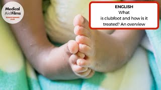 What is clubfoot and how is it treated An overview [upl. by Eitsyrc776]