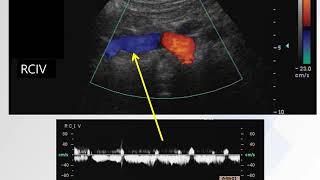 Extrinsic External Iliac Vein Compression [upl. by Aborn]