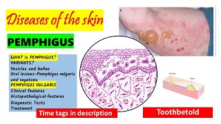 Pemphigus Vulgaris  HISTOPATHOLOGY  Immunofluorescence  Treatment  PART 22 [upl. by Rivers]