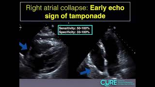 Pericardial Tamponade Echo [upl. by Carma]