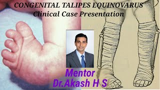 CONGENITAL TALIPES EQUINOVARUS Clinical Case Presentation [upl. by Aleihs]