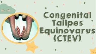 Congenital Talipes Equinovarus CTEV [upl. by Adianez]