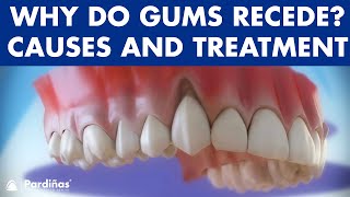 Gum recession  Treatment of gingival retraction © [upl. by Decca]