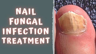 HOW TO TREAT FUNGAL NAIL INFECTION  TINEA UNGUIUM  ONYCHOMYCOSIS [upl. by Puiia995]