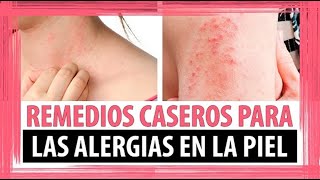 Los 3 tipos de ALERGIAS EN LA PIEL más comunes ⭐ ¿ Se cura la Dermatitis  ⭐ SmartSalus [upl. by Otiragram]