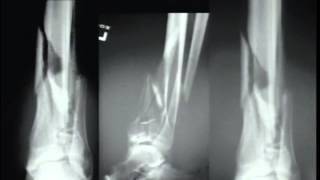 Pilon Fractures Management Options [upl. by Anelem]