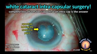 CataractCoach 1100 technique for very soft PSC cataract surgery [upl. by Schulman949]