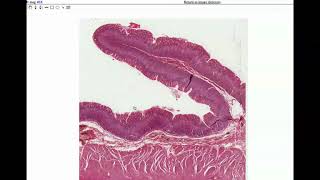 Abdominal Adhesions Causes Signs and Symptoms Diagnosis and Treatment [upl. by Sokem881]