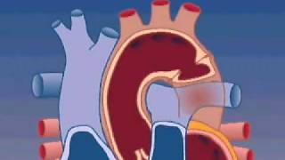 Coarctation of the Aorta treatment [upl. by Norm]