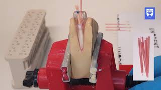 Endodontic treatment of the single rooted tooth Part 6 Obturation [upl. by Ludovick]