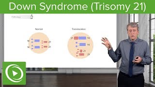 Trisomy 21 Etiology Pathology Diagnosis amp Management – Pediatrics  Lecturio [upl. by Adebayo]