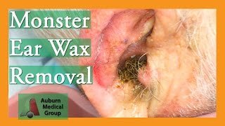 Monster Ear Wax Removal Brings New Life to JOKESTER Patient  Auburn Medical Group [upl. by Aelram]