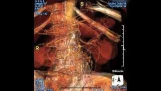 Iliac Artery Aneurysm Repair [upl. by Clifford795]