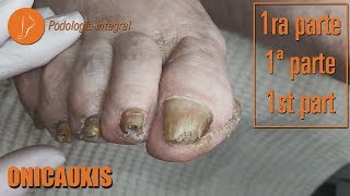 Onicauxis onychomycosis amp callosities Part 1 podologiaintegral [upl. by Tebzil828]