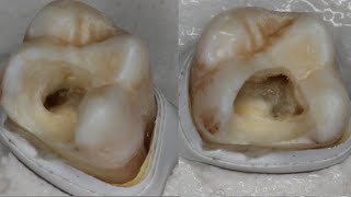 Endodontic series Part 1 Access opening [upl. by Ednew]