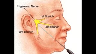 Trigeminal Neuralgia [upl. by Bak586]