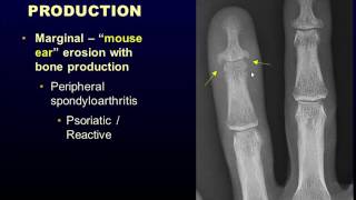 AOA Orthopedic Specialists  Facet Arthritis [upl. by Nylakcaj197]