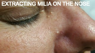 EXTRACTING MILIA ON THE NOSE [upl. by Athalla]