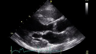 PVC Echo Parasternal Long Axis View  Aortic Stenosis [upl. by Eniagrom420]