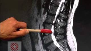 Low Back Pain Part 8 Spinal Stenosis [upl. by Arratoon]