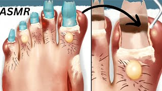 Oddly Satisfying ASMR  Ingrown Toenail Removal amp Foot Care Animation [upl. by Ardnaeel]