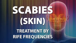 Scabies Skin  RIFE Frequencies Treatment  Energy amp Quantum Medicine with Bioresonance [upl. by Yokoyama145]