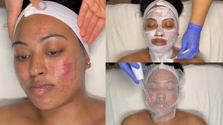 CYSTIC ACNE TREATMENT  WALKIN FACIAL FOR GRADE 3 AND 4 ACNE WITH PRO TIPS  LICENSED ESTHETICIAN [upl. by Chatterjee]