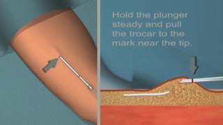 Pulmonary Artery Swan Ganz Catheter Insertion [upl. by Hurless]