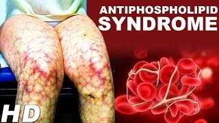 Antiphospholipid Antibody Syndrome An Autoimmune Disease  Antiphospholipid Treatments And Symptoms [upl. by Yelahc]