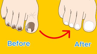 ASMR Ingrown toenail removal treatment animation [upl. by Ocsicnarf]