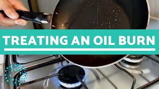 Treating an OIL BURN  What To Do [upl. by Dnarud]