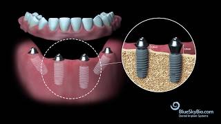 Blue Sky Bio Multi Unit Abutment [upl. by Fulviah]