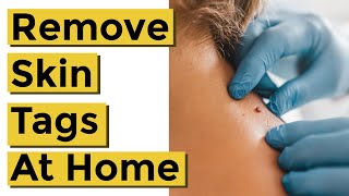 How to Quickly and Easily Remove Skin Tags at Home Using Things You Already Own [upl. by Aninaig796]