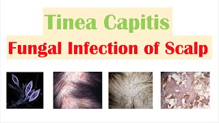 Fungal Infection of the Scalp Tinea Capitis  Causes Risk Factors Symptoms Diagnosis Treatment [upl. by Erv]