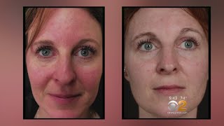 Health Watch New Laser Treatment For Rosacea [upl. by Llemij867]