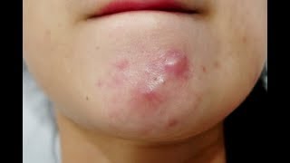 How to get rid of pimples under the skin I 2 Natural Home Remedies that works all the time [upl. by Aiderfla]