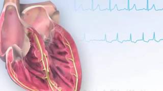 American Heart Association AHA Atrial Fibrillation Animation [upl. by Nylekoorb196]