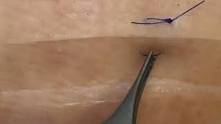 SUTURE REMOVAL  MATTRESS [upl. by Huesman]