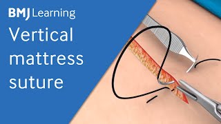 Vertical Mattress Suture  BMJ Learning [upl. by Azriel]