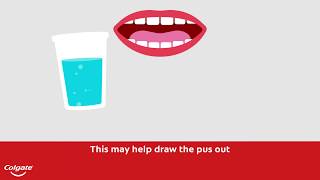 How To Treat a Gum or Tooth Abscess  Colgate® [upl. by Towroy]