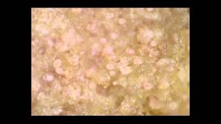 Scabies mites on skin crust [upl. by Bouton]