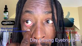 Eyebright healing my eyes from conjuctivitus with eyebright herb recommended by Dr Sebi [upl. by Ronnholm]