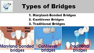 Types Of Dental Bridges [upl. by Anrat]