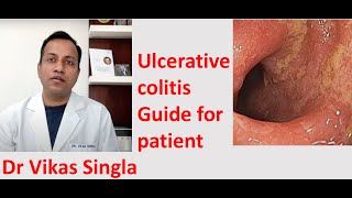 Ulcerative colitis Treatment and Symptoms अल्सरेटिव कोलाइटिस In Hindi Dr Vikas Singla [upl. by Auqenet]