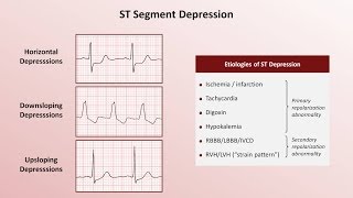 Intro to EKG Interpretation  QRST Changes [upl. by Kneeland]